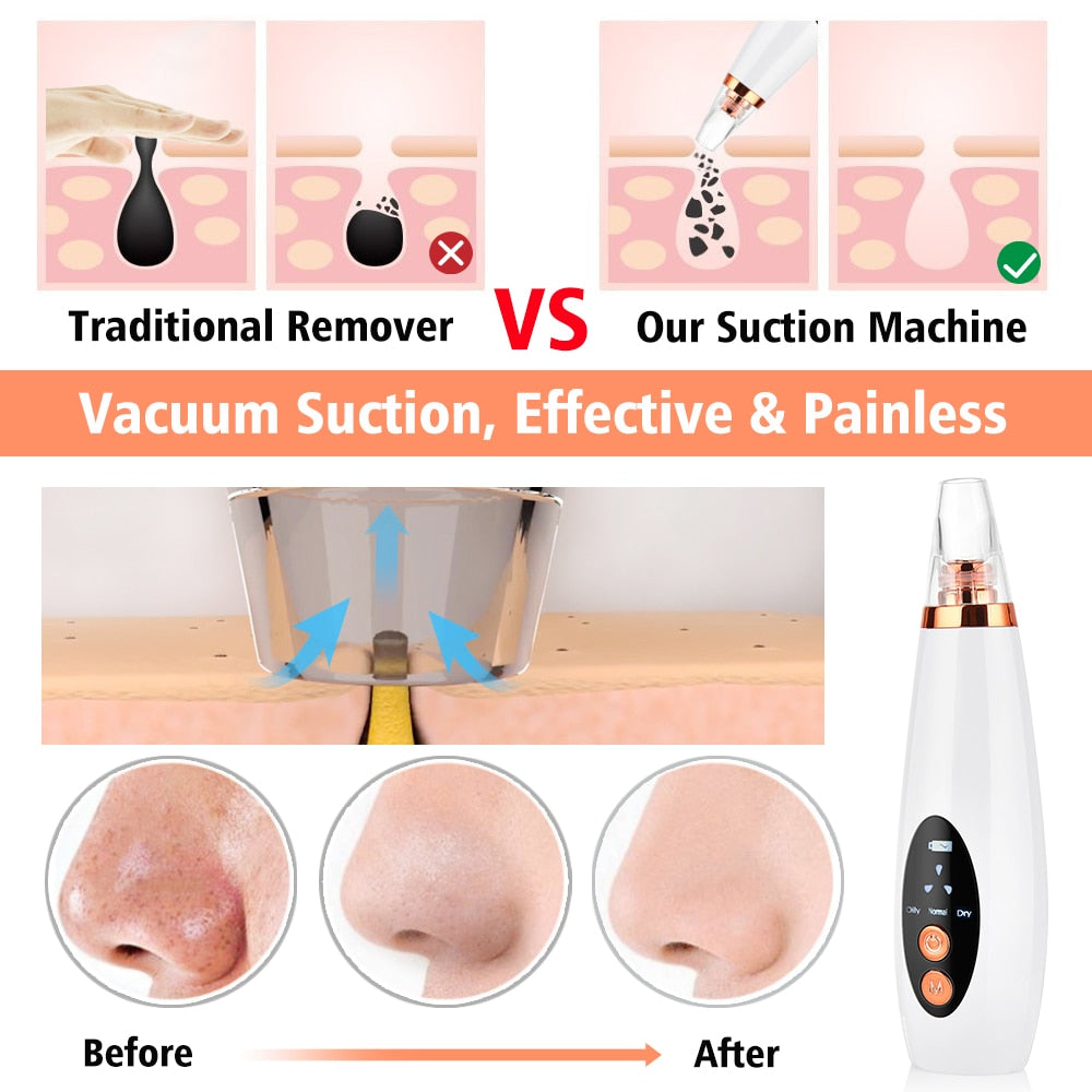 Blackhead Remover Vacuum