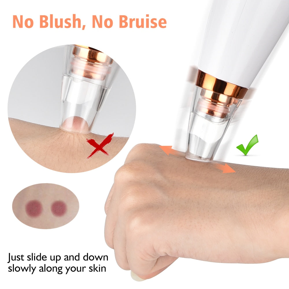 Blackhead Remover Vacuum